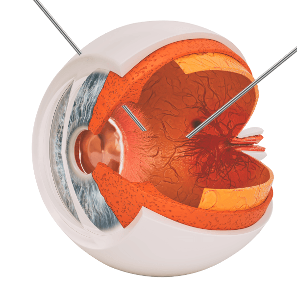 Vitrectomy