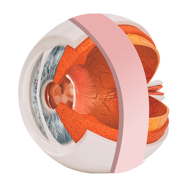 Scleral Buckling