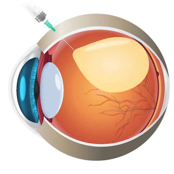 Pneumatic Retinopexy