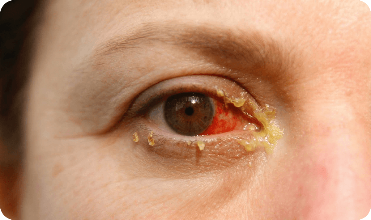 Redness and Discharge