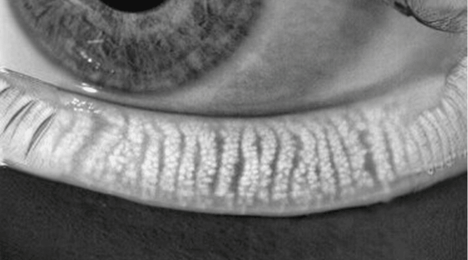 Meibomian gland oil layer secretion