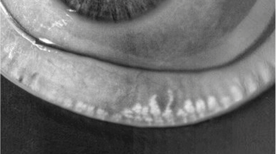 Meibomian gland oil layer secretion