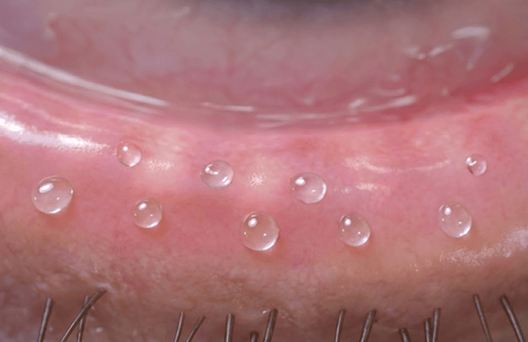 Meibomian gland oil layer secretion