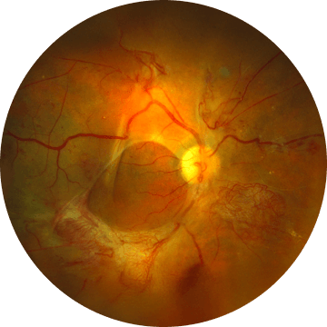 증식성 당뇨망막병증