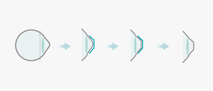 Ortho-K Correction Process