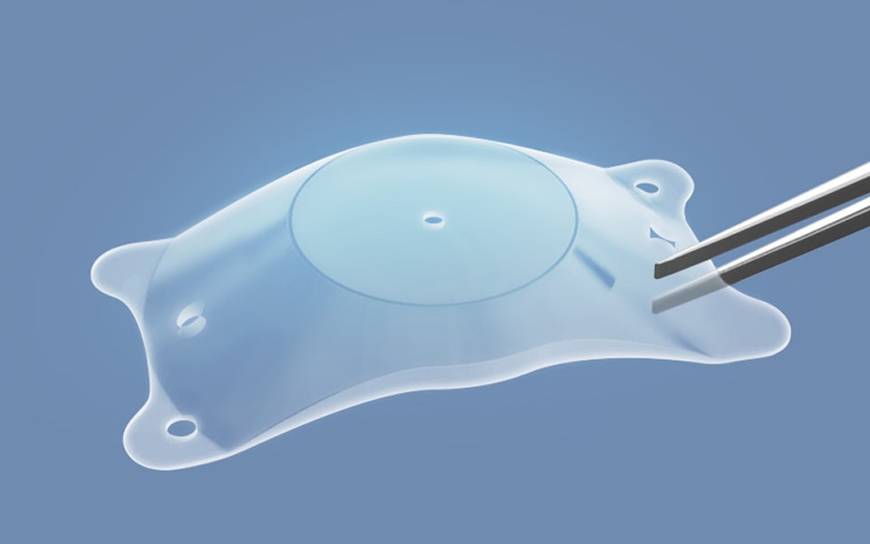 Lens Implantation Process