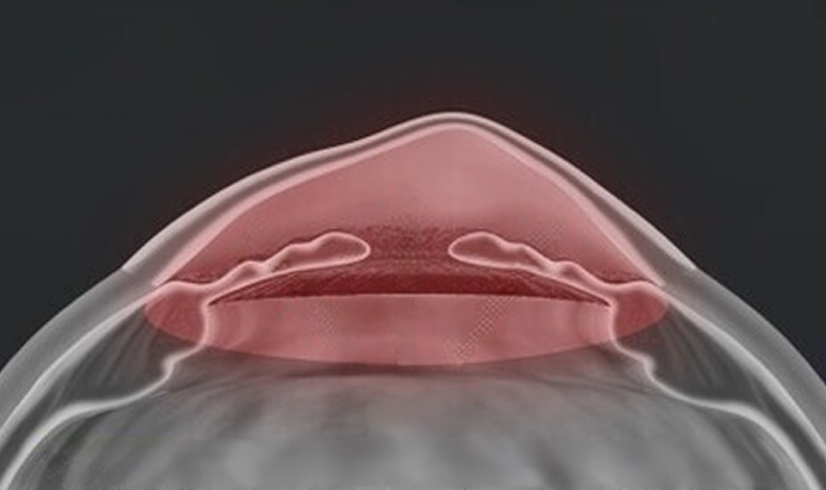 Thin or Asymmetric Cornea