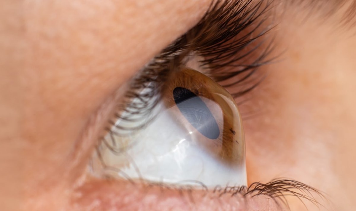 Keratoconus Concerns