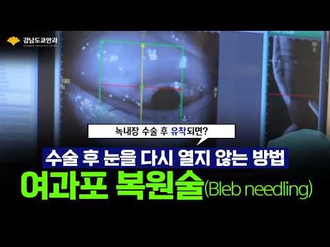 녹내장재수술 후 눈을 다시 열지 않는 여과포복원술