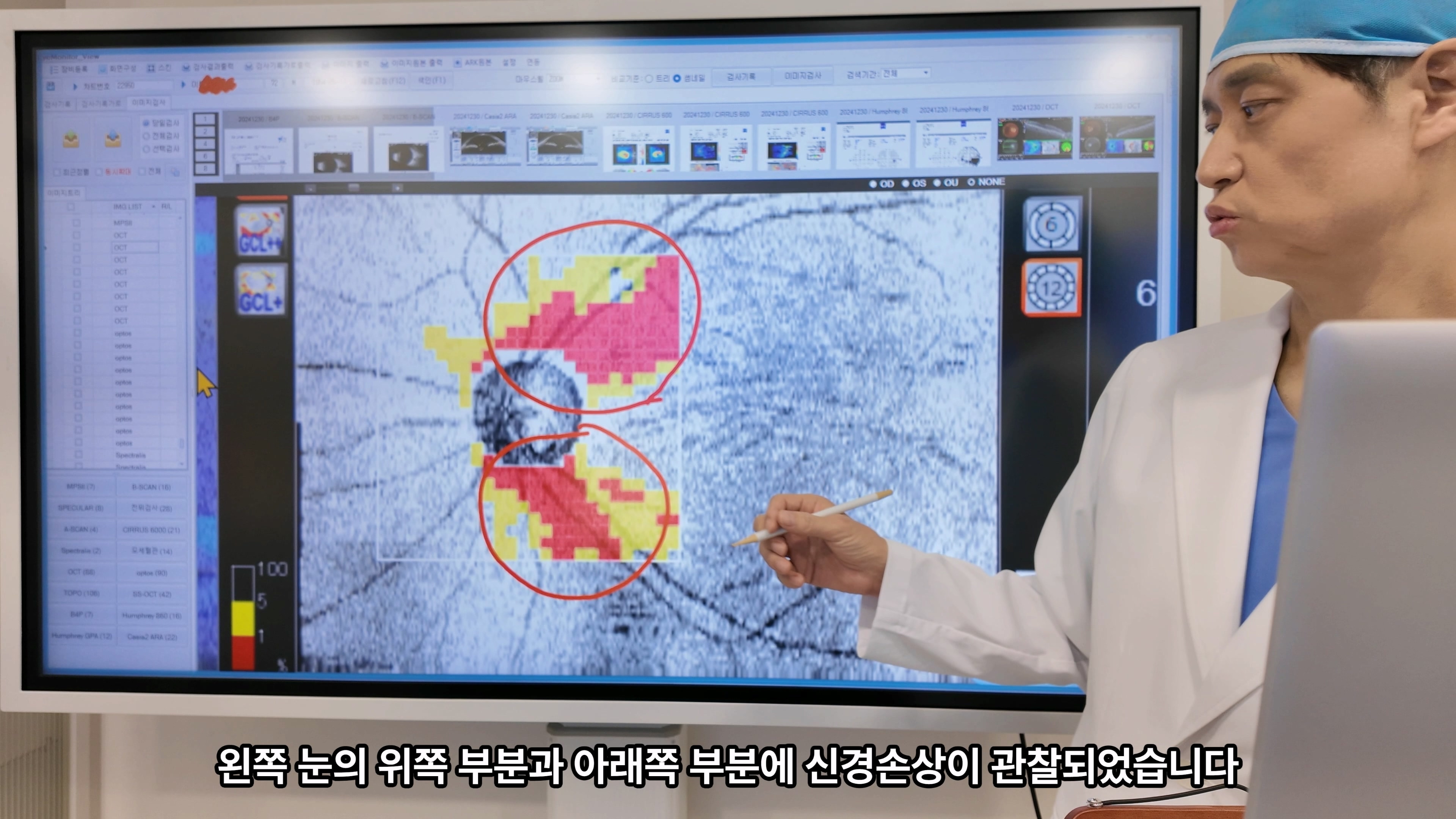70대초반 녹내장, 시신경섬유층얇아짐과 좌안시야결손을 함께 확인한 섬유주 절제 수술 경과