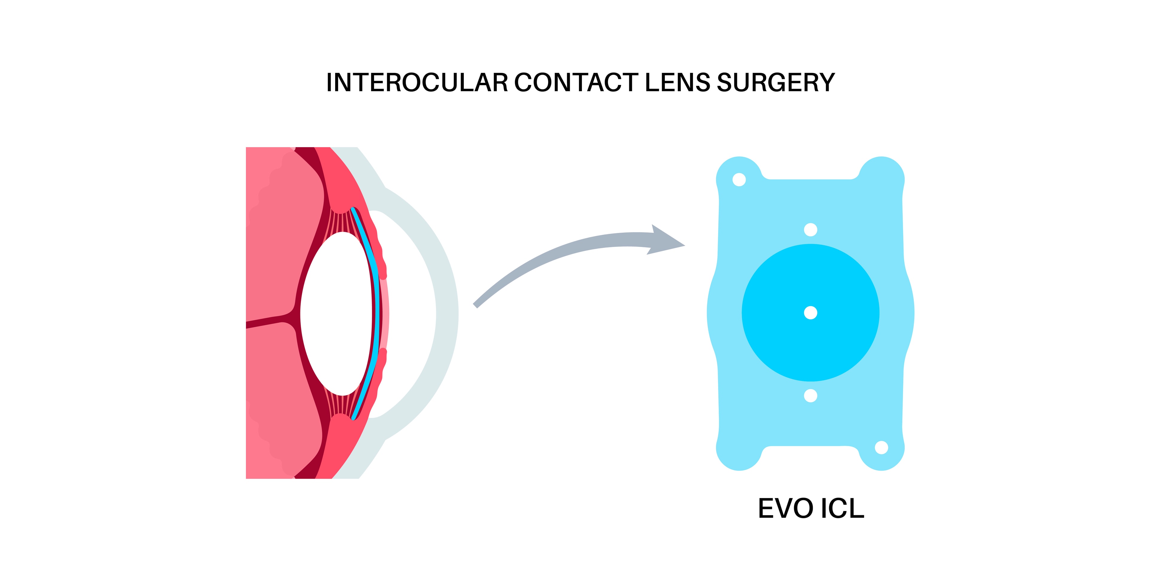 강남렌즈삽입술, 각막을 보존하는 ICL 시력교정 기준