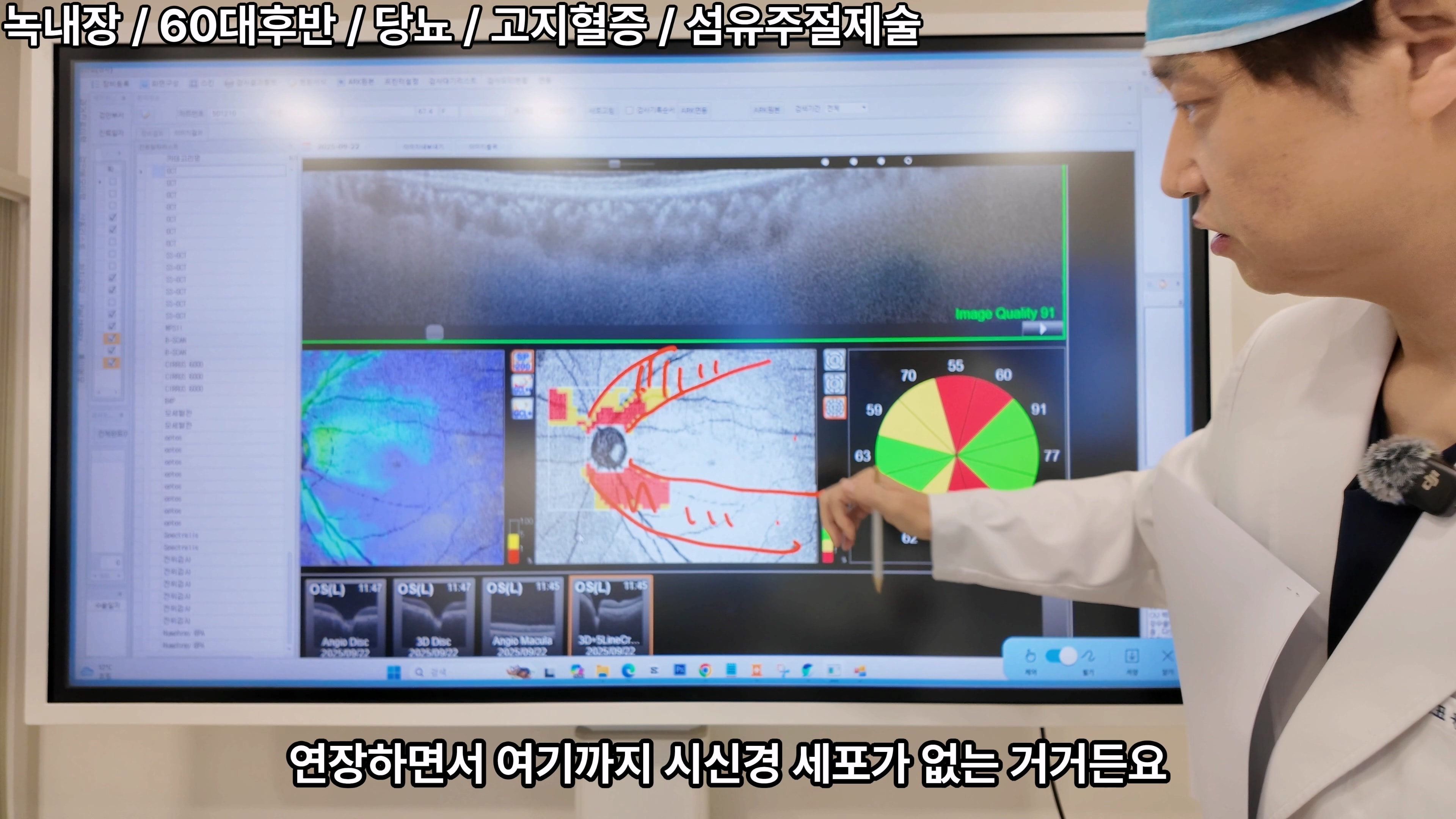 60대후반 녹내장 환자의 당뇨·고지혈증 동반 섬유주절제술 치료 경과와 안압 관리 사례