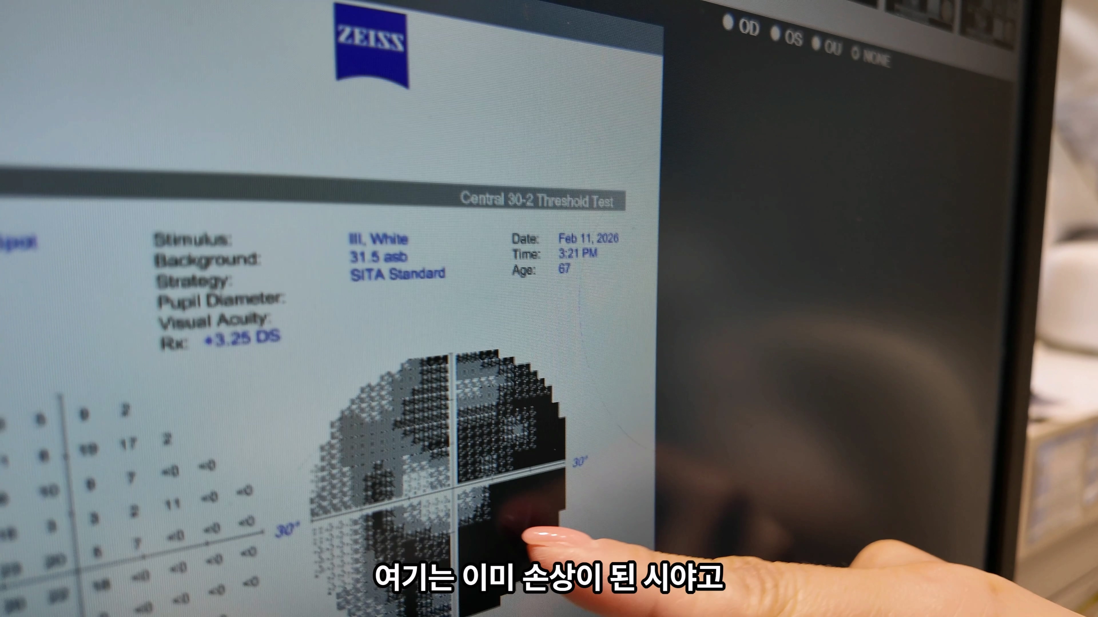 정상안압녹내장과 중심시야손상, 안압이 정상이어도 확인이 필요한 이유