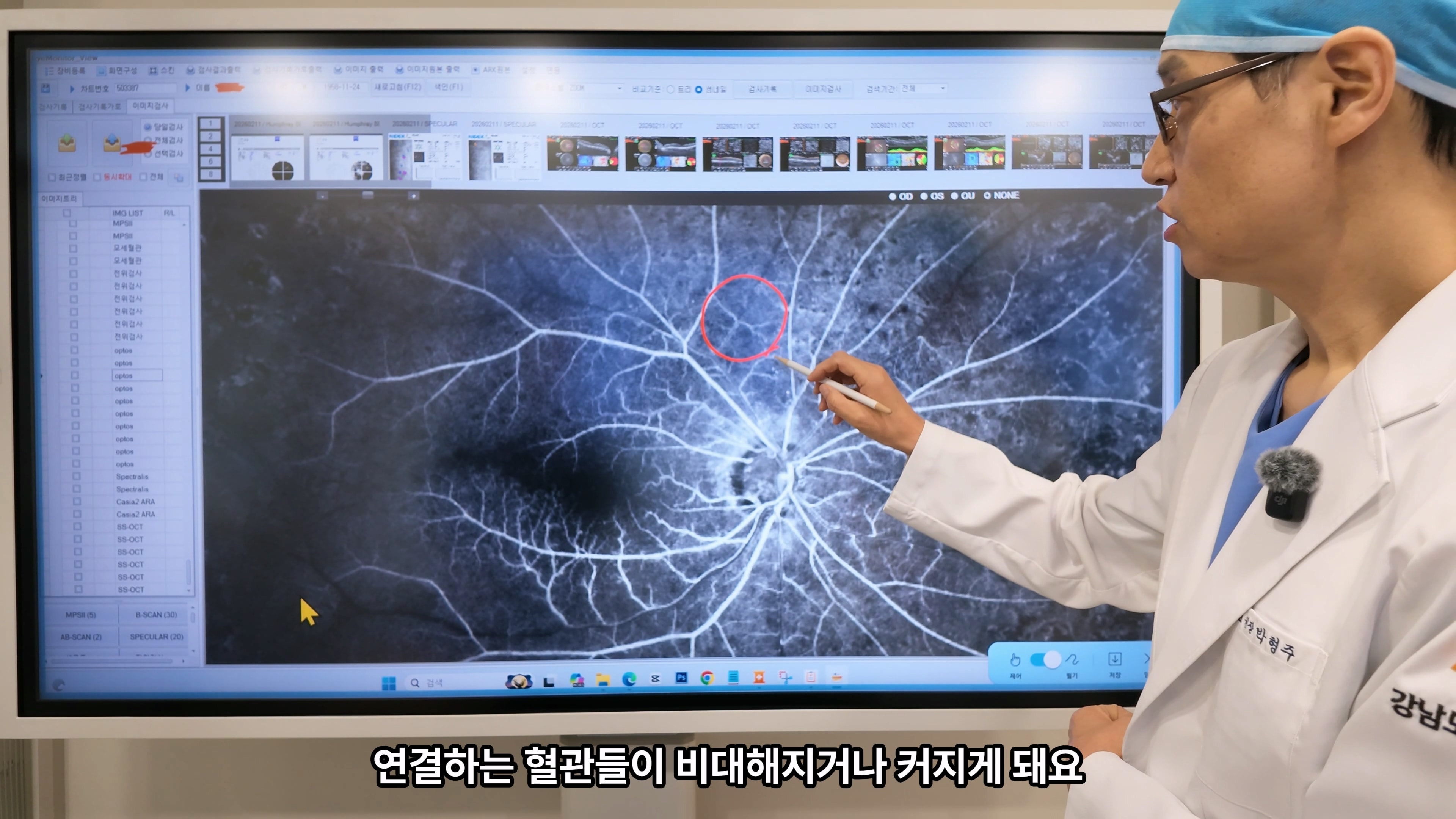 60대후 녹내장, 우안 시기능 저하와 좌안섬유주절제술 치료 계획