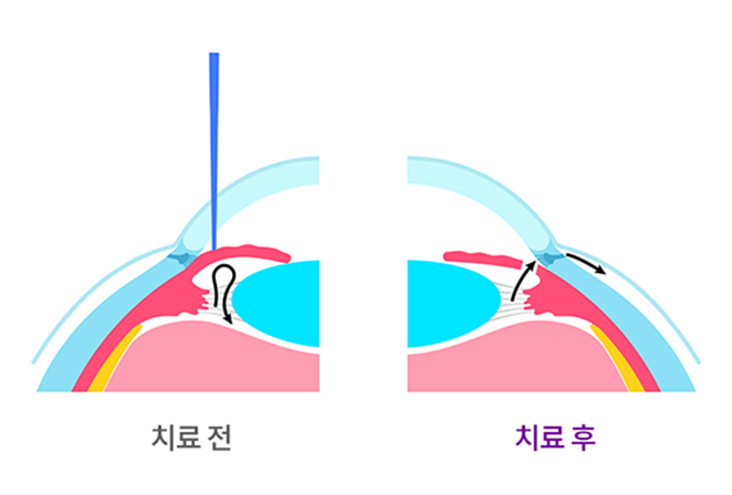 치료 전후이미지