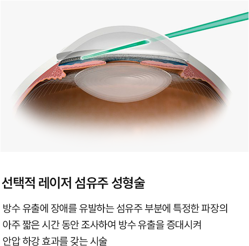 선택적 레이저 섬유주 성형술술