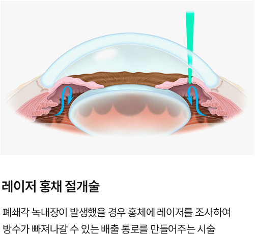 레이저 홍채 절재술