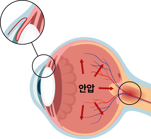 안압 이미지