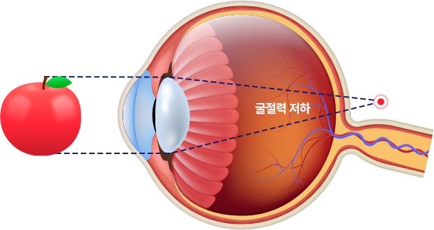 안압 이미지