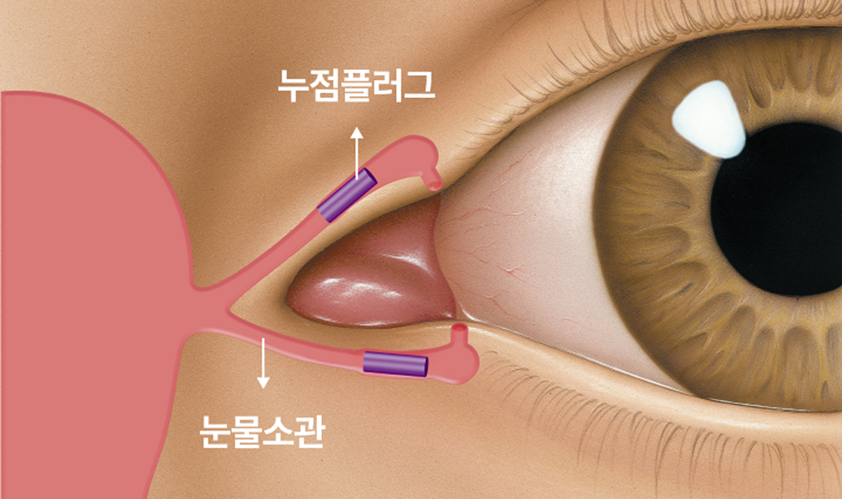 Customized Plugs Based on Patient Condition