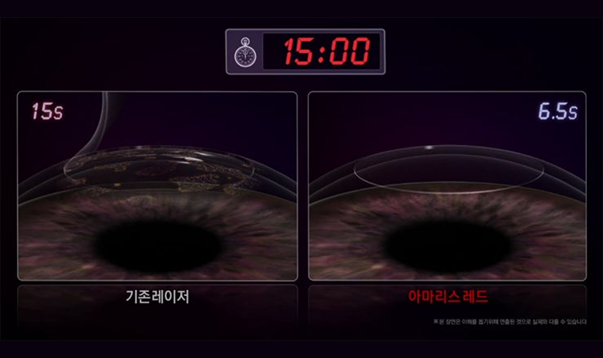 기존 레이저와 아마리스 레드의 레이저 조사 시간 비교 이미지